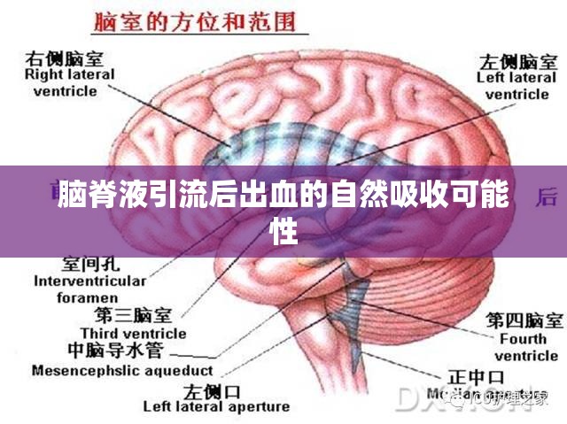 腦脊液引流后出血的自然吸收可能性
