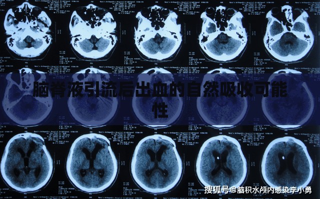 腦脊液引流后出血的自然吸收可能性