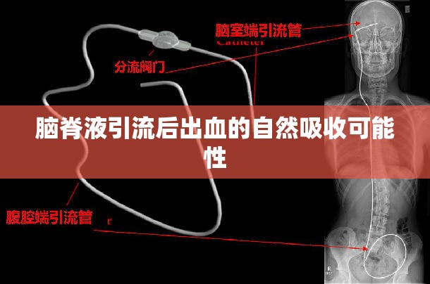 腦脊液引流后出血的自然吸收可能性