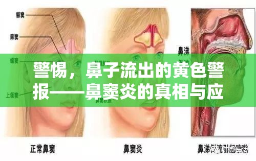 警惕，鼻子流出的黃色警報——鼻竇炎的真相與應對策略