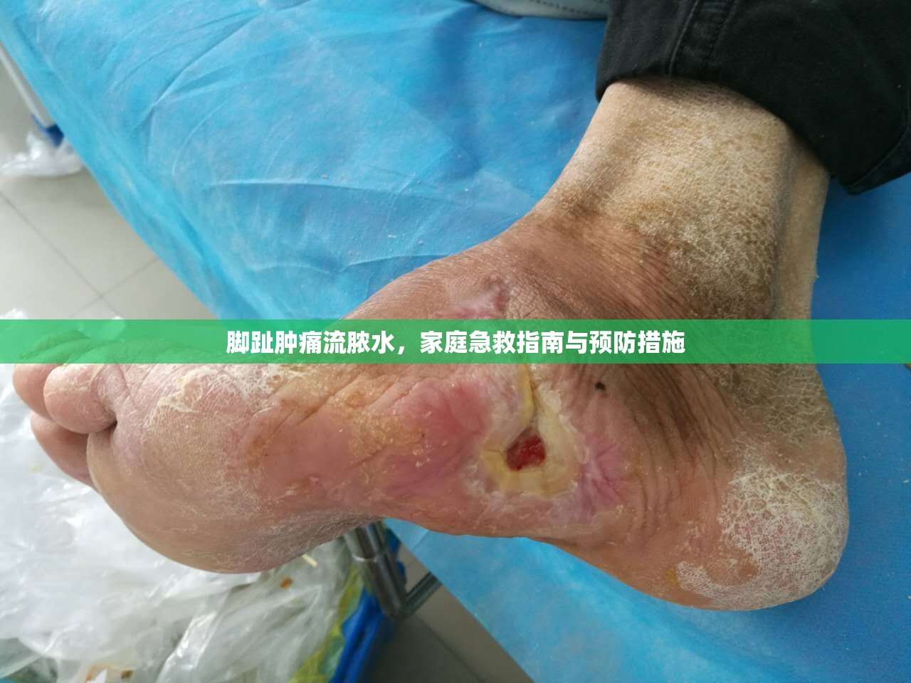 腳趾腫痛流膿水，家庭急救指南與預防措施