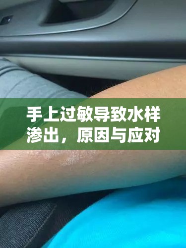 手上過敏導(dǎo)致水樣滲出，原因與應(yīng)對措施