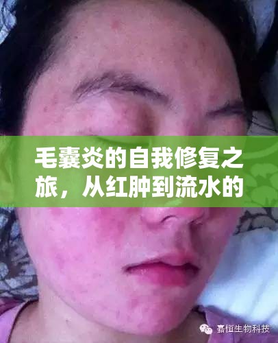 毛囊炎的自我修復(fù)之旅，從紅腫到流水的奇妙轉(zhuǎn)變