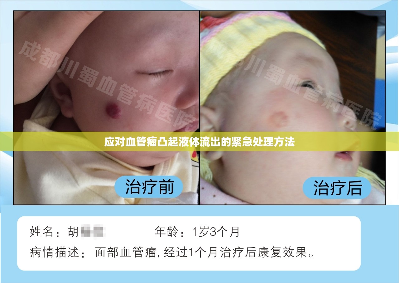 應(yīng)對血管瘤凸起液體流出的緊急處理方法