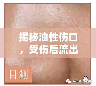 揭秘油性傷口，受傷后流出的神秘油脂