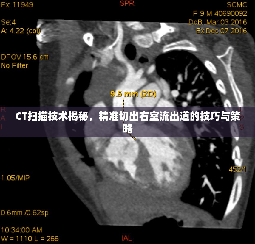 CT掃描技術(shù)揭秘，精準切出右室流出道的技巧與策略
