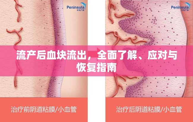 流產(chǎn)后血塊流出，全面了解、應(yīng)對(duì)與恢復(fù)指南