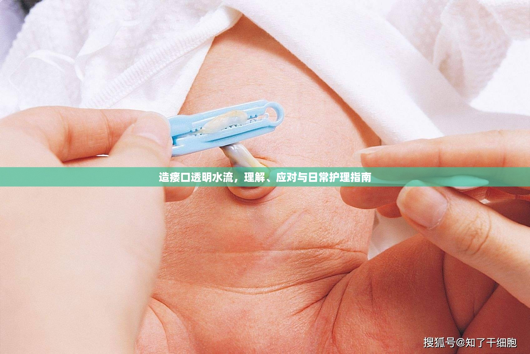 造瘺口透明水流，理解、應(yīng)對與日常護(hù)理指南