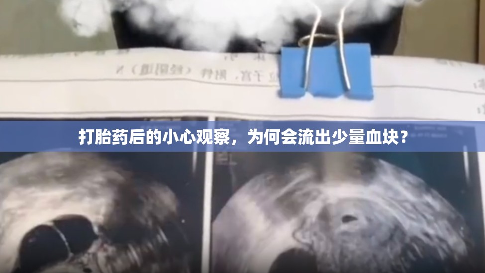 打胎藥后的小心觀察，為何會流出少量血塊？