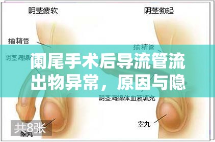 闌尾手術(shù)后導(dǎo)流管流出物異常，原因與隱憂