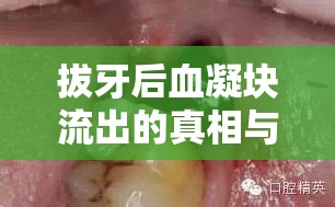 拔牙后血凝塊流出的真相與應(yīng)對(duì)措施，不容忽視的血色警報(bào)