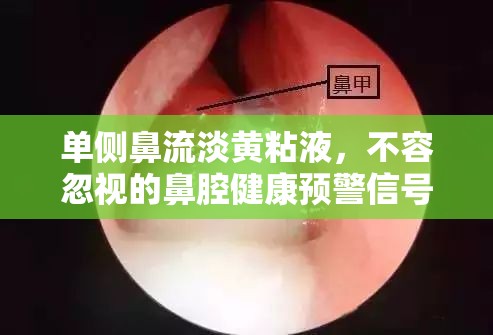 單側(cè)鼻流淡黃粘液，不容忽視的鼻腔健康預警信號
