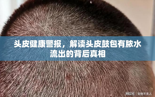 頭皮健康警報(bào)，解讀頭皮鼓包有膿水流出的背后真相