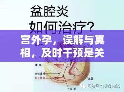 宮外孕，誤解與真相，及時干預(yù)是關(guān)鍵