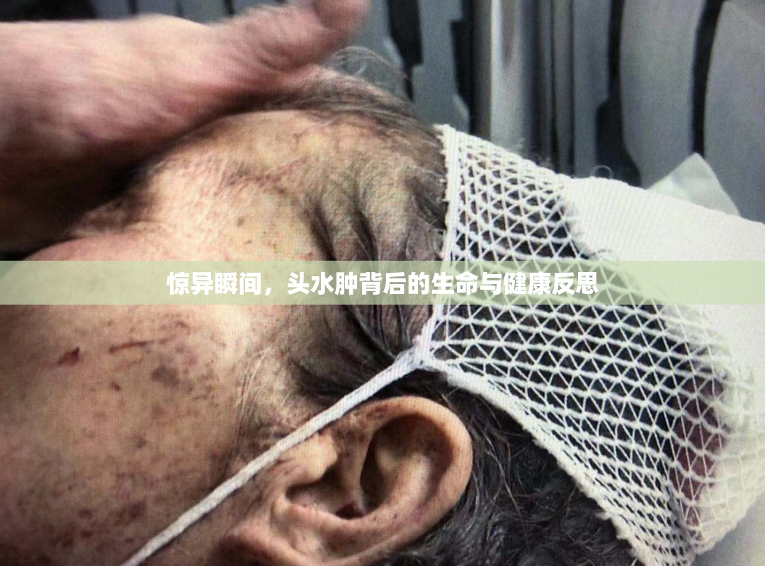 驚異瞬間，頭水腫背后的生命與健康反思