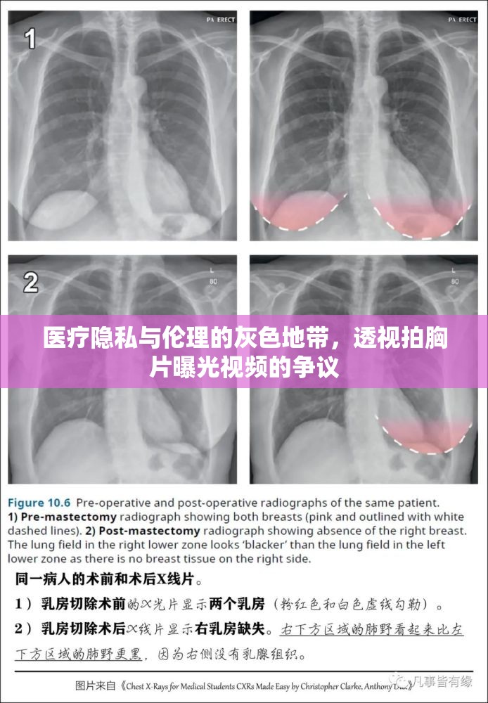 醫(yī)療隱私與倫理的灰色地帶，透視拍胸片曝光視頻的爭議