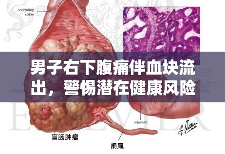 男子右下腹痛伴血塊流出，警惕潛在健康風(fēng)險(xiǎn)