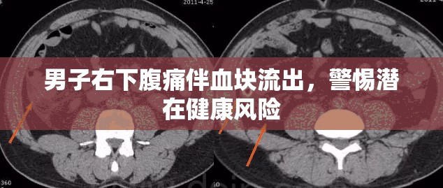 男子右下腹痛伴血塊流出，警惕潛在健康風(fēng)險(xiǎn)