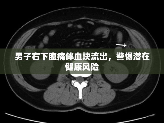 男子右下腹痛伴血塊流出，警惕潛在健康風(fēng)險(xiǎn)