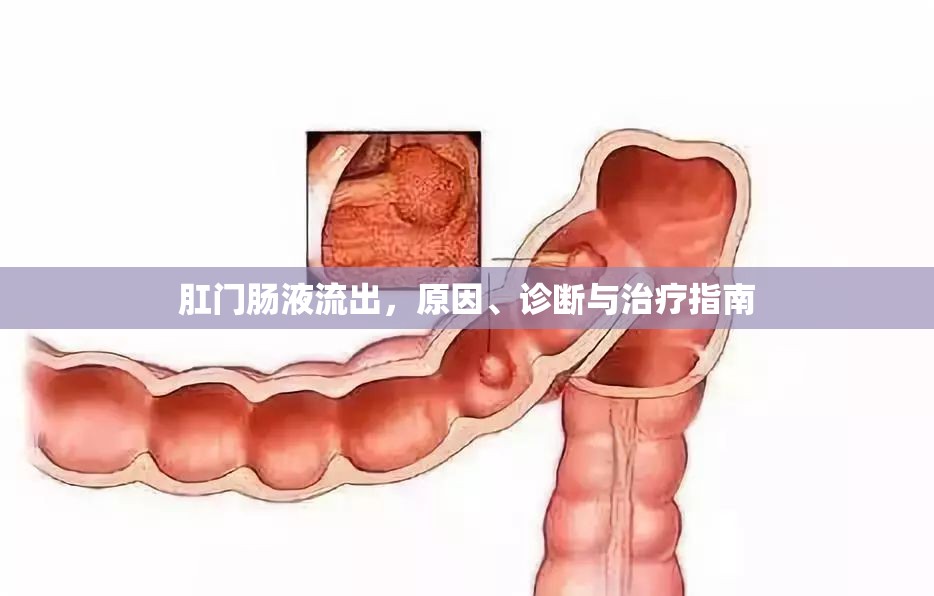 肛門腸液流出，原因、診斷與治療指南