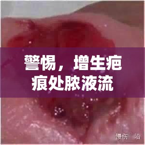 警惕，增生疤痕處膿液流出，潛在健康警報(bào)與應(yīng)對(duì)策略