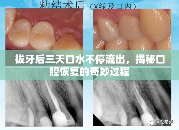 拔牙后三天口水不停流出，揭秘口腔恢復(fù)的奇妙過(guò)程