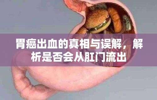 胃癌出血的真相與誤解，解析是否會從肛門流出