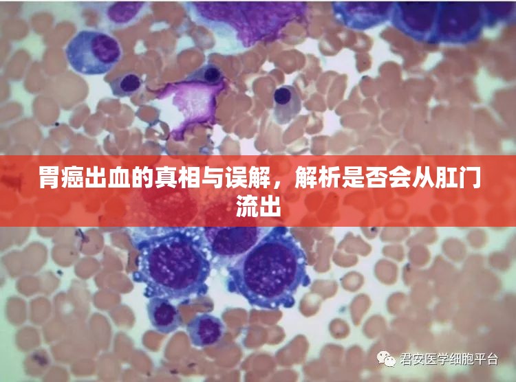 胃癌出血的真相與誤解，解析是否會從肛門流出