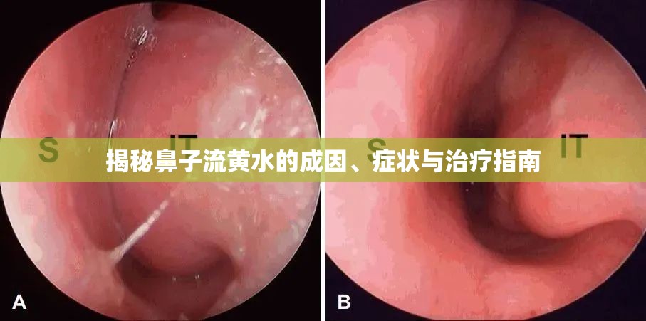 揭秘鼻子流黃水的成因、癥狀與治療指南