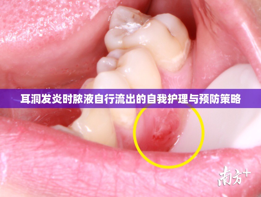 耳洞發(fā)炎時膿液自行流出的自我護理與預防策略