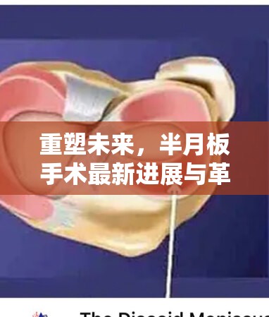 重塑未來(lái)，半月板手術(shù)最新進(jìn)展與革新