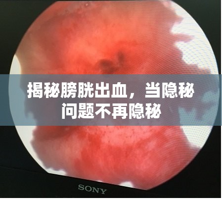 揭秘膀胱出血，當(dāng)隱秘問題不再隱秘