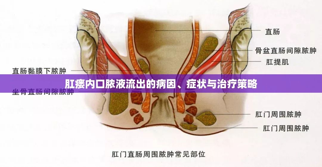 肛瘺內(nèi)口膿液流出的病因、癥狀與治療策略