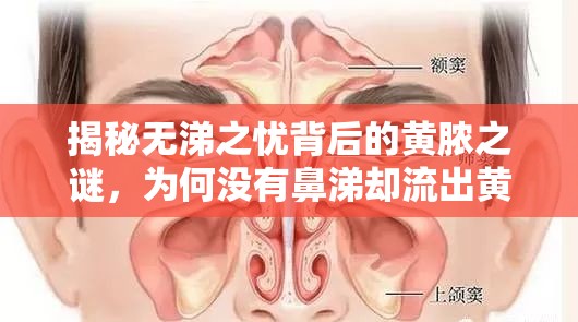 揭秘無涕之憂背后的黃膿之謎，為何沒有鼻涕卻流出黃色膿液？