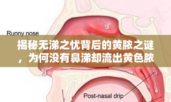 揭秘無涕之憂背后的黃膿之謎，為何沒有鼻涕卻流出黃色膿液？